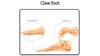 Claw foot
 