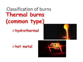 Classification of burns
Thermal burns
(common type)
hydrothermal
hot metal
 
