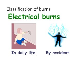 Classification of burns
Electrical burns
By accident
In daily life
 