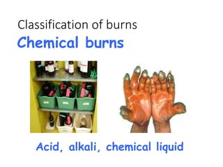 Classification of burns
Chemical burns
Acid, alkali, chemical liquid
 