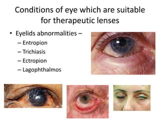 Conditions of eye which are suitable
for therapeutic lenses
• Eyelids abnormalities –
– Entropion
– Trichiasis
– Ectropion
– Lagophthalmos
 