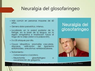 Neuralgia del glosofaringeo
 