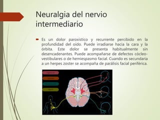 Neuralgia del nervio
intermediario
 Es un dolor paroxístico y recurrente percibido en la
profundidad del oído. Puede irradiarse hacia la cara y la
órbita. Este dolor se presenta habitualmente sin
desencadenantes. Puede acompañarse de defectos cócleo-
vestibulares o de hemiespasmo facial. Cuando es secundaria
a un herpes zoster se acompaña de parálisis facial periférica.
 