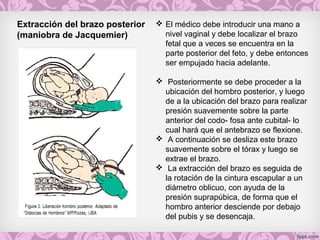 Extracción del brazo posterior
(maniobra de Jacquemier)
 El médico debe introducir una mano a
nivel vaginal y debe localizar el brazo
fetal que a veces se encuentra en la
parte posterior del feto, y debe entonces
ser empujado hacia adelante.
 Posteriormente se debe proceder a la
ubicación del hombro posterior, y luego
de a la ubicación del brazo para realizar
presión suavemente sobre la parte
anterior del codo- fosa ante cubital- lo
cual hará que el antebrazo se flexione.
 A continuación se desliza este brazo
suavemente sobre el tórax y luego se
extrae el brazo.
 La extracción del brazo es seguida de
la rotación de la cintura escapular a un
diámetro oblicuo, con ayuda de la
presión suprapúbica, de forma que el
hombro anterior desciende por debajo
del pubis y se desencaja.
 