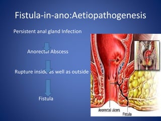 Fistula-in-ano:Aetiopathogenesis
Persistent anal gland Infection
Anorectal Abscess
Rupture inside as well as outside
Fistula
 