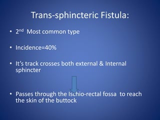Trans-sphincteric Fistula:
• 2nd Most common type
• Incidence=40%
• It’s track crosses both external & Internal
sphincter
• Passes through the Ischio-rectal fossa to reach
the skin of the buttock
 