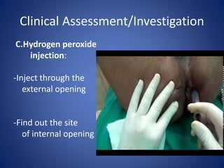 Clinical Assessment/Investigation
C.Hydrogen peroxide
injection:
-Inject through the
external opening
-Find out the site
of internal opening
 