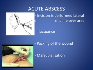 ACUTE ABSCESS
-- Incision is performed lateral
to midline midline over area
of maximum
fluctuance
- Packing of the wound
- Marsupialisation
 