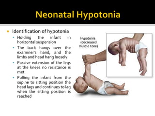  Identification of hypotonia
 Holding the infant in
horizontal suspension
 The back hangs over the
examiner's hand, and the
limbs and head hang loosely
 Passive extension of the legs
at the knees no resistance is
met
 Pulling the infant from the
supine to sitting position the
head lags and continues to lag
when the sitting position is
reached
 