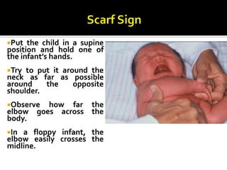 Put the child in a supine
position and hold one of
the infant’s hands.
Try to put it around the
neck as far as possible
around the opposite
shoulder.
Observe how far the
elbow goes across the
body.
In a floppy infant, the
elbow easily crosses the
midline.
 