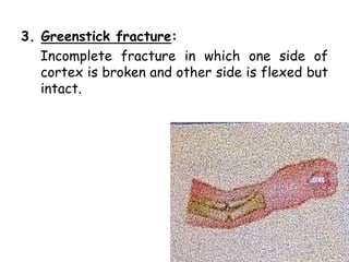 3. Greenstick fracture:
Incomplete fracture in which one side of
cortex is broken and other side is flexed but
intact.
 