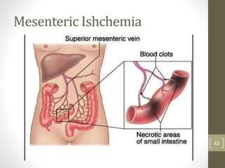 Mesenteric Ishchemia
42
 