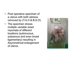 • Post operative specimen of
a uterus with both adnexa
removed by (T.A.H & B.S.O).
• The specimen shows
multiple variable sized
myomata of different
locations (submucous,
subserous and even broad
ligamentary) resulting in
Asymmetrical enlargement
of uterus.
 