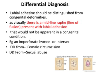 Differential Diagnosis
• Labial adhesive should be distinguished from
congenital deformities,
• as visually there is a mid-line raphe (line of
fusion) present with labial adhesion
• that would not be apparent in a congenital
condition.
• Eg an imperforate hymen or Intersex
• DD from-- Female circumcision
• DD From--Sexual abuse
 