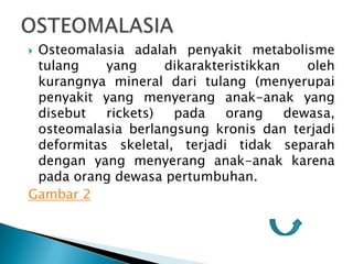 Osteomalasia adalah penyakit metabolisme
 tulang    yang     dikarakteristikkan    oleh
 kurangnya mineral dari tulang (menyerupai
 penyakit yang menyerang anak-anak yang
 disebut   rickets)  pada    orang     dewasa,
 osteomalasia berlangsung kronis dan terjadi
 deformitas skeletal, terjadi tidak separah
 dengan yang menyerang anak-anak karena
 pada orang dewasa pertumbuhan.
Gambar 2
 
