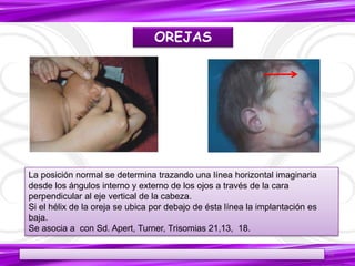 La posición normal se determina trazando una línea horizontal imaginaria
desde los ángulos interno y externo de los ojos a través de la cara
perpendicular al eje vertical de la cabeza.
Si el hélix de la oreja se ubica por debajo de ésta línea la implantación es
baja.
Se asocia a con Sd. Apert, Turner, Trisomias 21,13, 18.
OREJAS
16
 