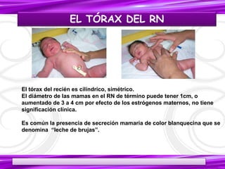 EL TÓRAX DEL RN
19/05/2017
El tórax del recién es cilíndrico, simétrico.
El diámetro de las mamas en el RN de término puede tener 1cm, o
aumentado de 3 a 4 cm por efecto de los estrógenos maternos, no tiene
significación clínica.
Es común la presencia de secreción mamaria de color blanquecina que se
denomina “leche de brujas”.
25
 