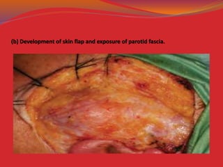 (b) Development of skin flap and exposure of parotid fascia.
 