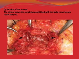 (g) Excision of the tumour.
The picture shows the remaining parotid bed with the facial nerve branch
intact (arrows).
 