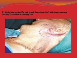 (c) Skin incision outlined for radical neck dissection and left radical parotidectomy
including the removal of overlying skin.
 