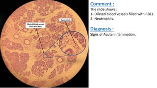 Dilated blood vessels
Filled with RBCs
Neutrophils
Comment :
The slide shows :
1- Dilated blood vessels filled with RBCs.
2- Neutrophils.
Diagnosis :
Signs of Acute inflammation.