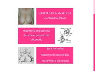 HIPERTROFIA MAMARIA DE
LA ADOLESCENCIA
Hipertrofia del estroma
durante el periodo del
desarrollo
-Base hormonal
-Repercusión psicológica
-Tratamiento quirúrgico
 