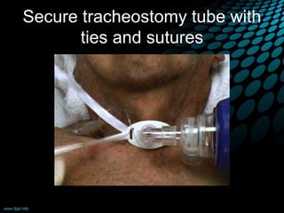 Secure tracheostomy tube with
ties and sutures
 