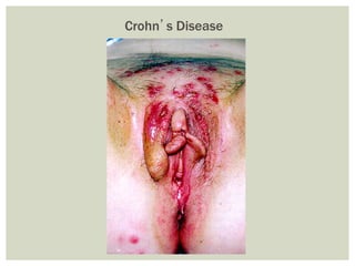Crohn’s Disease
 