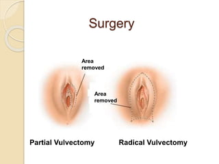 Surgery
Area
removed
Area
removed
Partial Vulvectomy Radical Vulvectomy
 