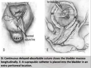 Vesico-Vaginal Fistula (VVF)