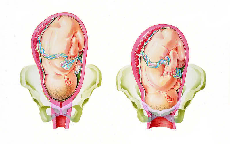 To tegninger der man kan se hvordan babyen ligger inni livmora til kvinnen. Livmora er plassert i bekkenet, som er en del av skjelettet. På begge tegningene ligger babyen med hodet nedover og ryggen vendt halvt til siden. Armene og beina er tett inntil kroppen, og navlestrengen går fra en fortykning i veggen på livmora og rundt magen til babyen. På den første tegningen ligger livmora et stykke over bekkenet, og man kan se at mormunnen er lang og lukket under hodet til babyen. På det andre bildet ligger hodet til babyen og livmora nede i bekkenet, og man kan se at mormunnen er mye tynnere. 